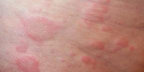 Allergi hos barnet: alt foreldrene trenger å vite om diagnostisering og behandling