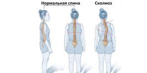 Hva er skoliose og hvordan å fikse det