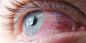 Konjunktivitt: hvorfor rødme øynene og hvordan å behandle dem
