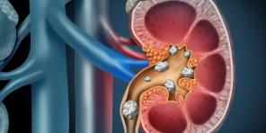 Hva forårsaker nyrestein og hvordan å hindre det