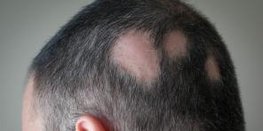 Alopecia: hvorfor du mister hår og hvordan du behandler det