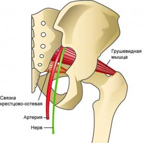 Hva er piriformis syndrom og hvordan bli kvitt det