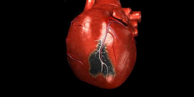 Symptomer på hjerteinfarkt, som du trenger for å ringe en ambulanse