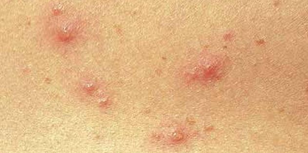 Symptomer på vannkopper hos barn og voksne: Ganske ofte, huden umiddelbart vises små røde prikker